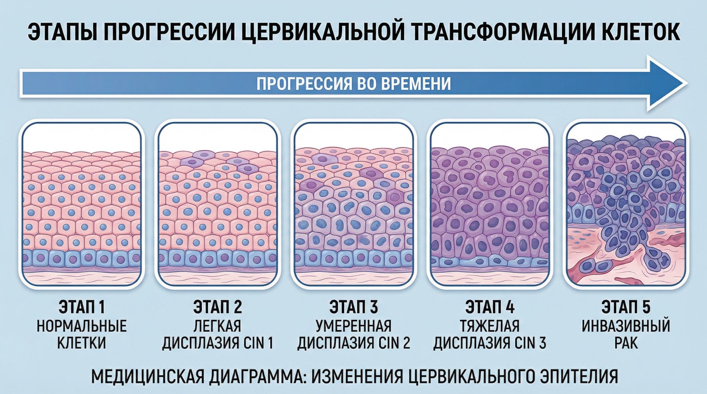 Progressive stages of cervical cancer development timeline